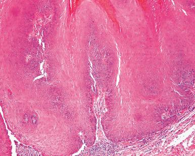 Figure 4.21, Verrucous Carcinoma of Tongue.