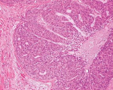 Figure 4.22, Basaloid Squamous Cell Carcinoma.