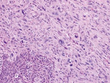 Figure 4.23, Spindle Cell (Sarcomatoid) Carcinoma.