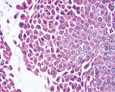 Figure 4.25, Myoepithelioma exclusively composed of so-called hyaline or plasmacytoid cells.