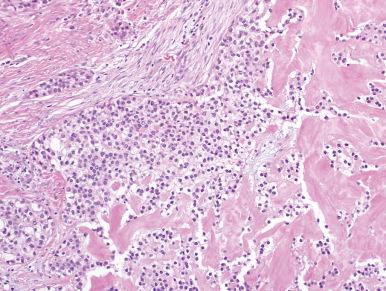 Figure 4.26, Clear Cell Carcinoma of Minor Salivary Glands.