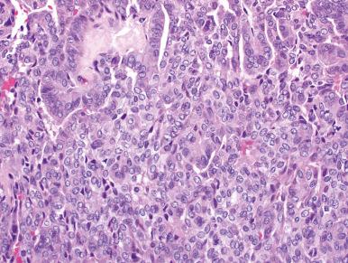 Figure 4.28, Polymorphous Low-Grade Adenocarcinoma.