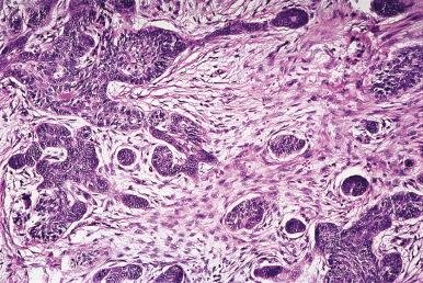 Figure 4.29, Peripheral Ameloblastoma.