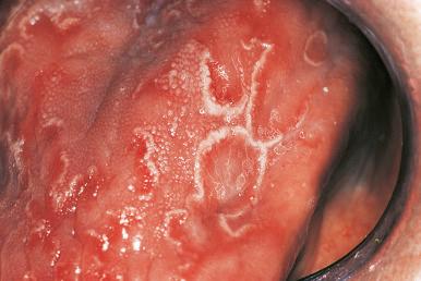 Figure 4.4, Clinical Appearance of Geographic Tongue.