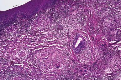 Figure 4.5, Lip Biopsy in a Patient With Melkersson–Rosenthal Syndrome.