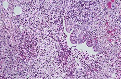 Figure 4.6, Tongue Ulceration With Eosinophilia.