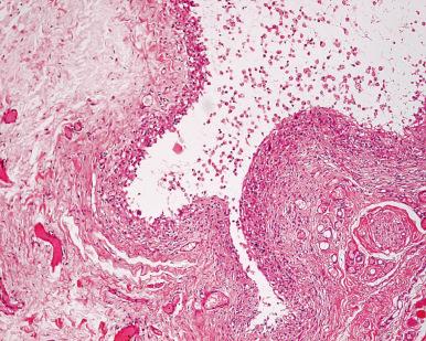 Figure 4.7, Extravasation Mucocele.