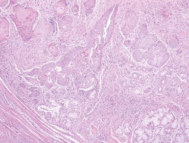 Figure 4.8, Necrotizing sialometaplasia. The retained lobular configuration is an important diagnostic clue.