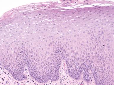 Figure 4.10, Keratosis Without Dysplasia.