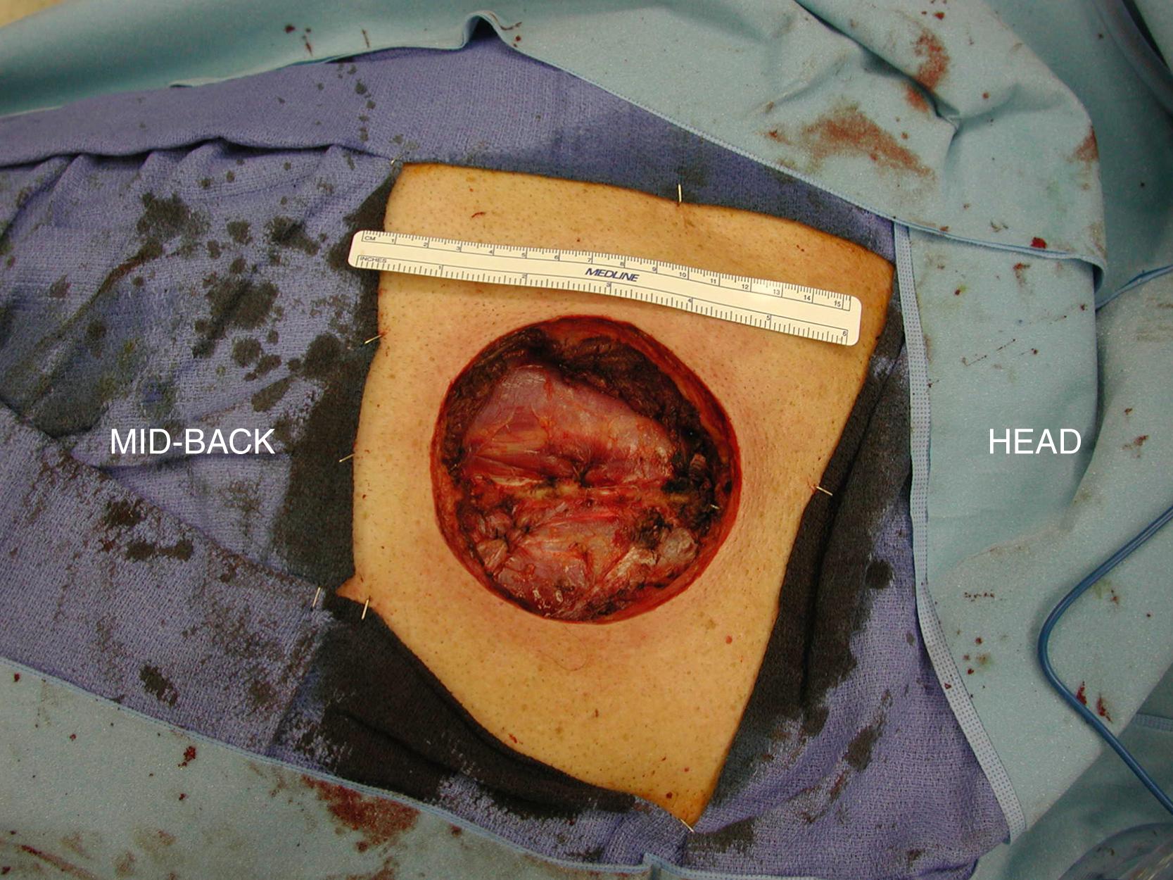 Fig. 28.1, Preoperative view showing a large soft tissue defect, measuring 12 × 12 cm, in the midline of the upper back down to the deep muscle after a wide local excision for soft tissue sarcoma.