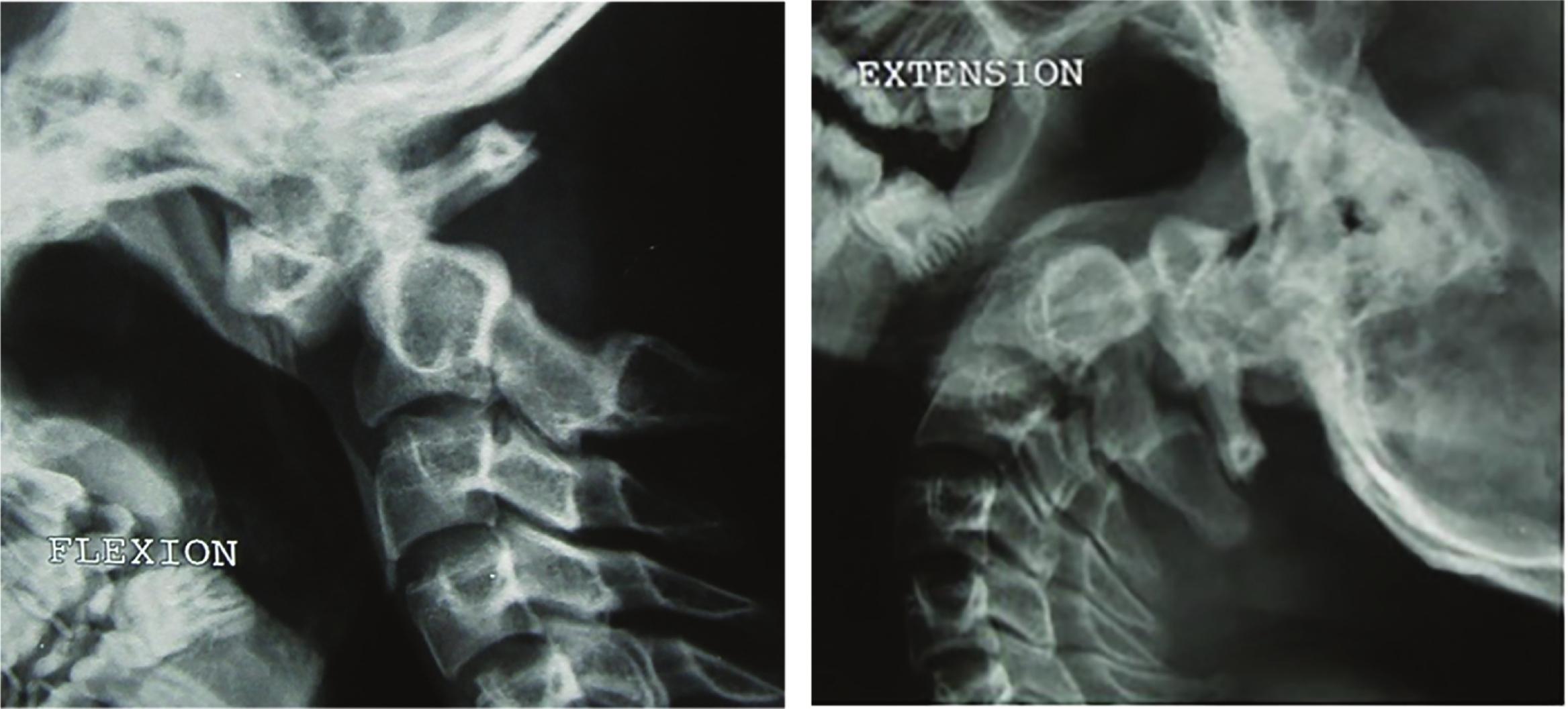 Fig. 1, (A) Lateral flexion cervical spine X-ray showing atlantoaxial dislocation. (B) Lateral extension cervical spine X-ray showing reduction of the atlantoaxial dislocation.