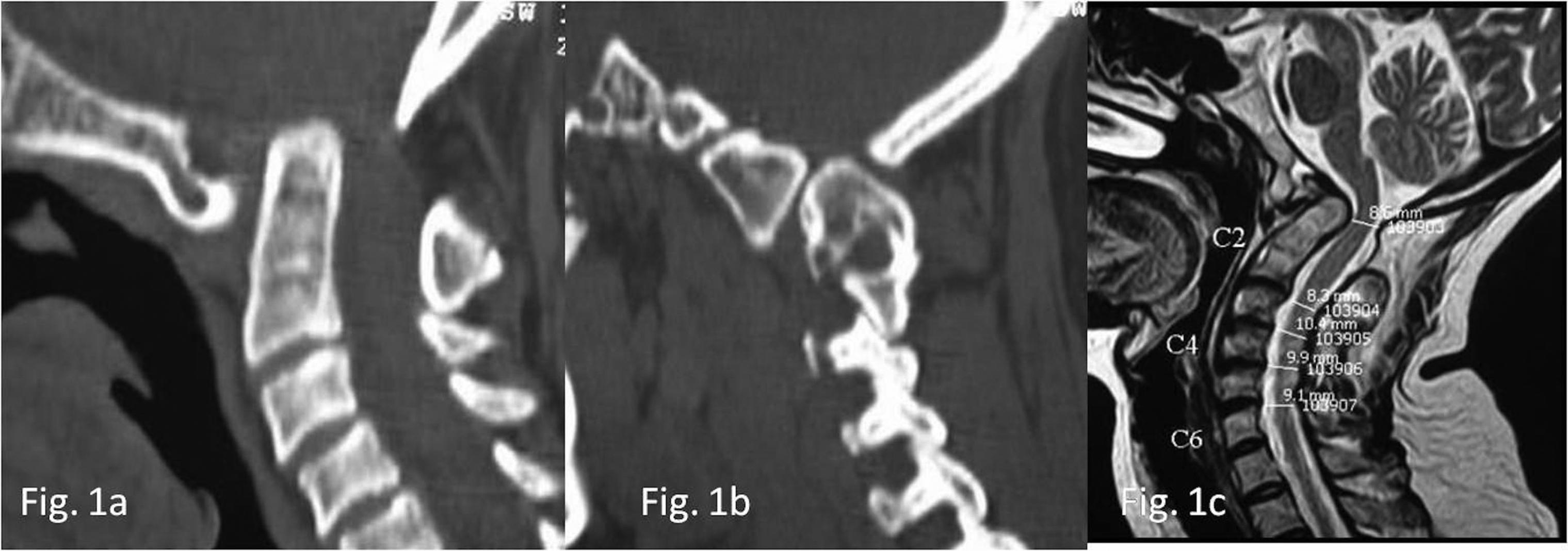 Fig. 2, (A) Computed tomographic (CT) scan showing assimilation of atlas, C2-C3 fusion, basilar invagination, and atlantoaxial instability. (B) Sagittal image of CT scan showing type A atlantoaxial facetal dislocation. (C) Magnetic resonance imaging (MRI) showing the cord compression.