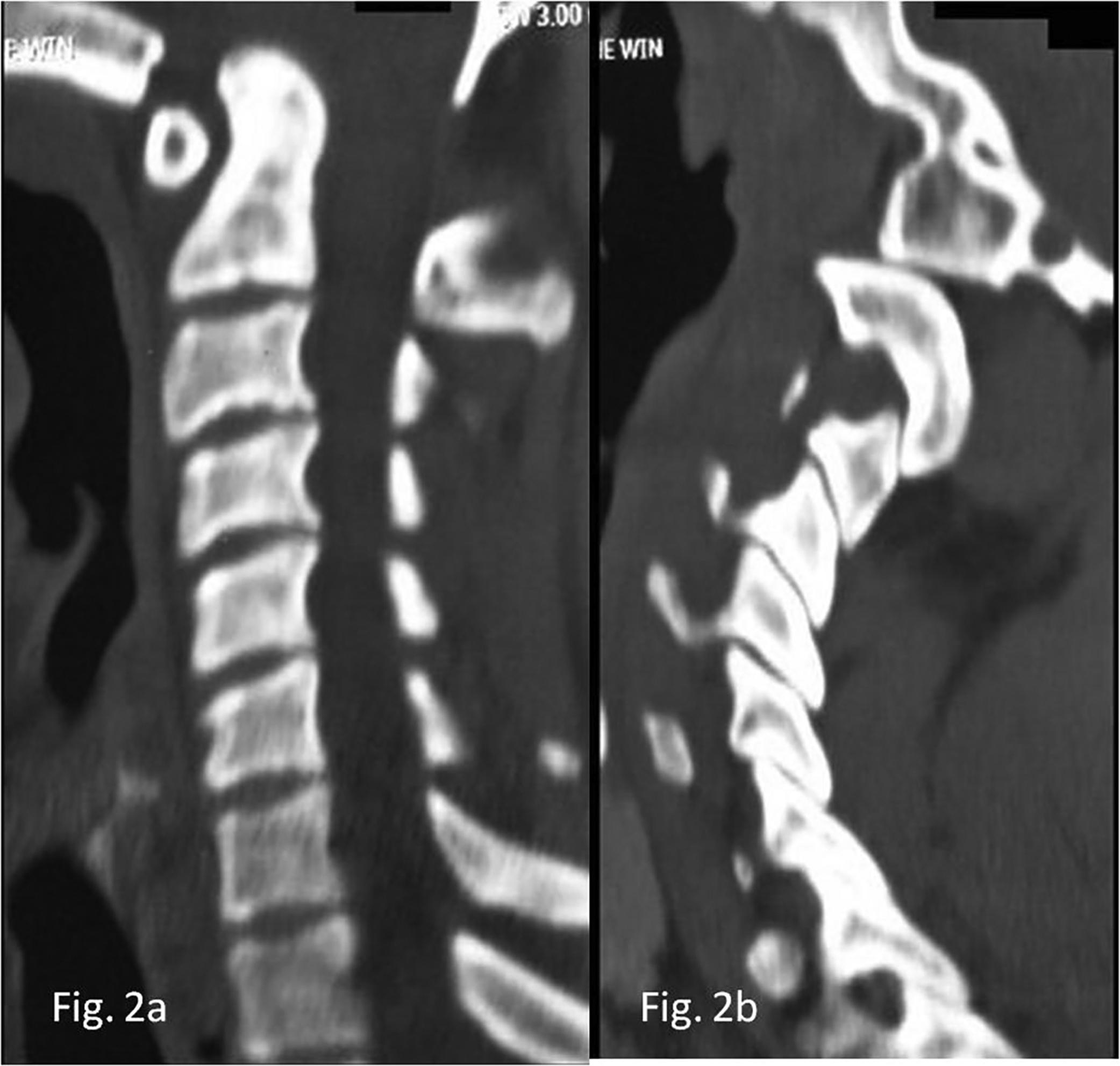 Fig. 3, (A) Sagittal CT scan showing basilar invagination. (B) Sagittal CT scan showing type B atlantoaxial facet dislocation.