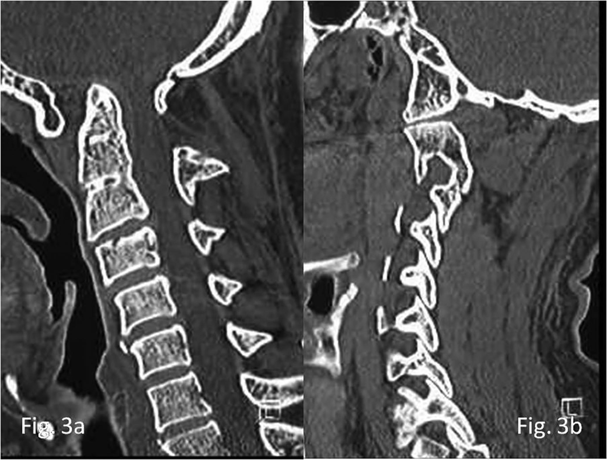 Fig. 4, (A) Sagittal CT scan shows partial assimilation of atlas and C2-C3 fusion. Basilar invagination is present. (B) Sagittal image of the facets showing facets in alignment or type C atlantoaxial facet dislocation.