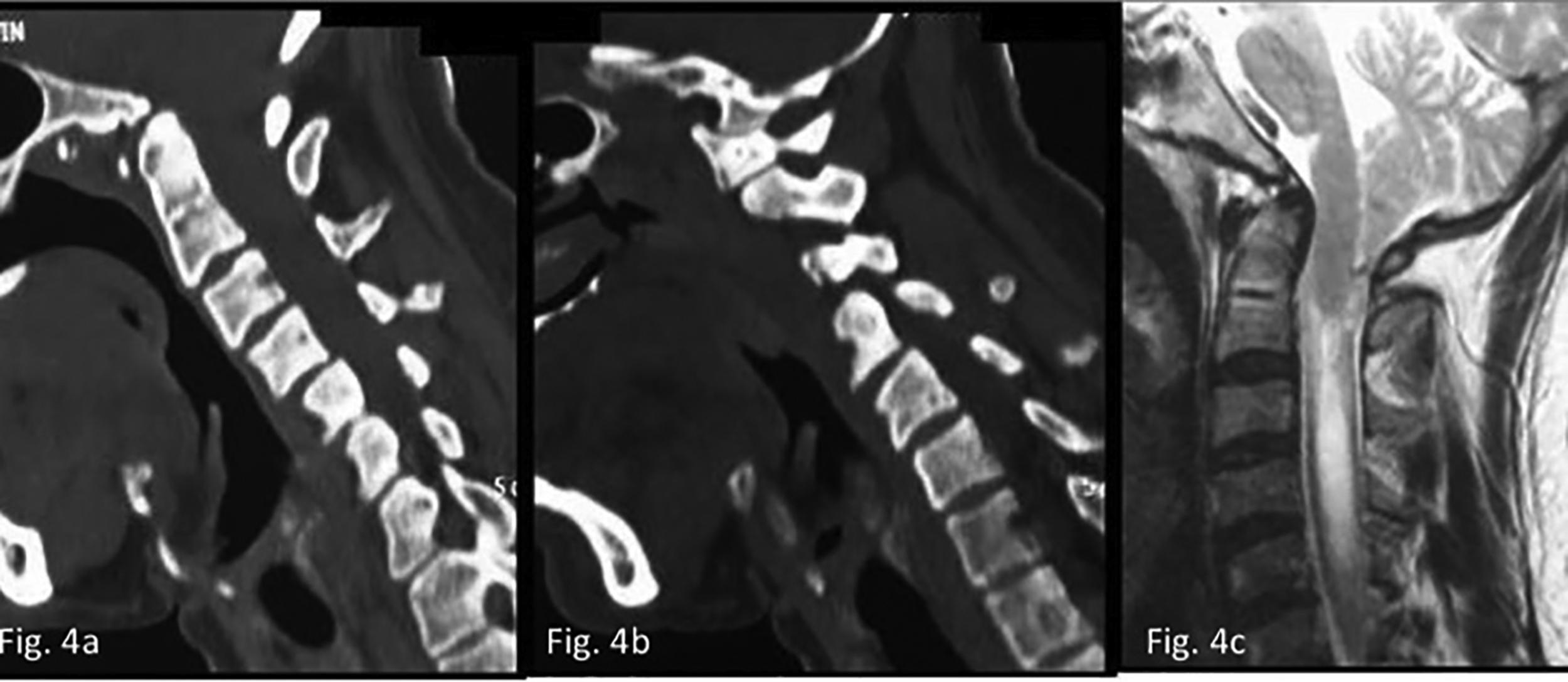Fig. 5, (A) CT scan shows mild basilar invagination. There is no evidence of any clear atlantoaxial instability as assessed by increased atlantodental interval. (B) Sagittal image of the facets does not show any malalignment. The dislocation in this case is an example of type C facet instability and is identified only during direct surgical handling. (C) Magnetic resonance imaging shows basilar invagination, Chiari malformation, and syringomyelia.