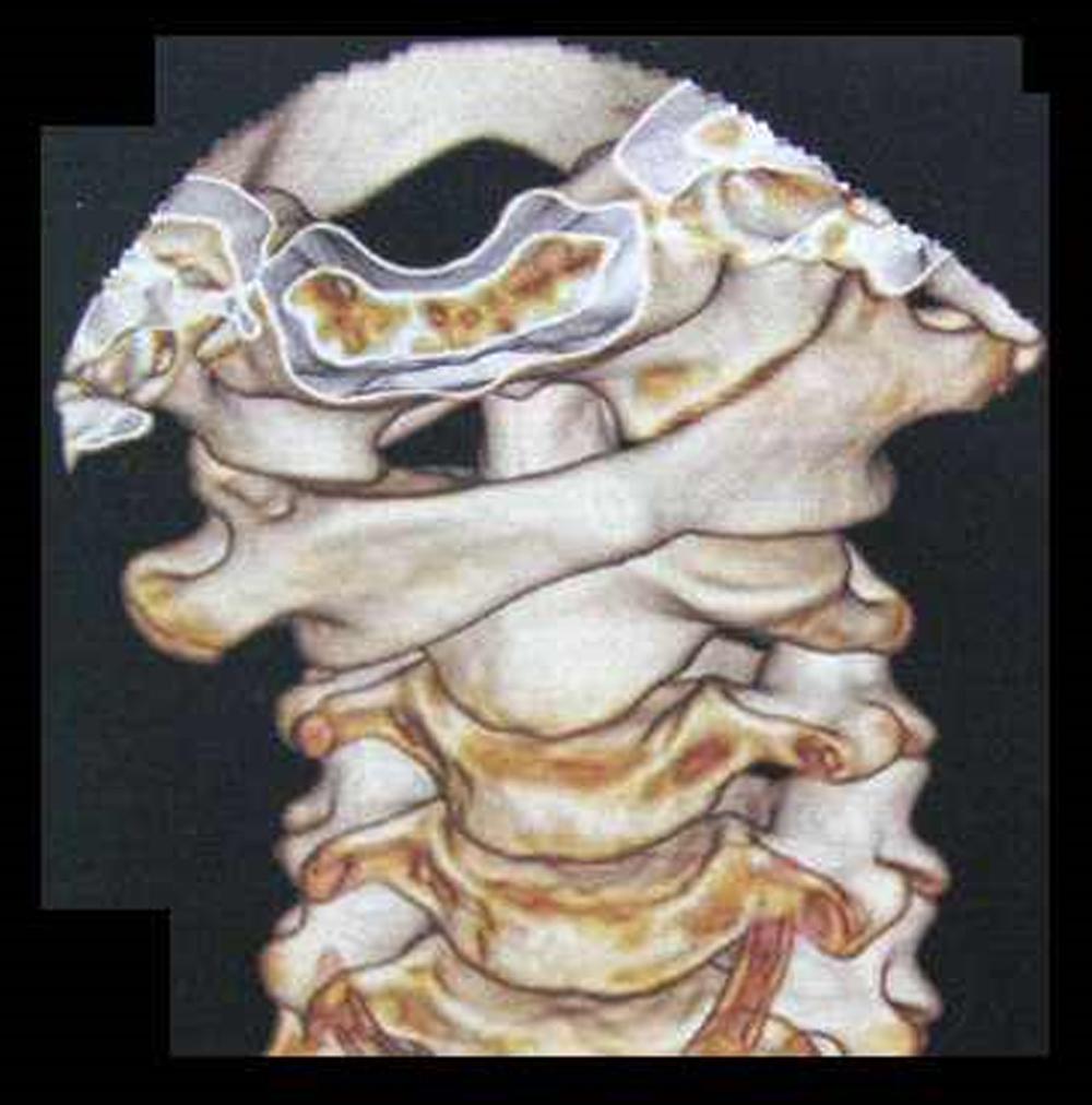 Fig. 6, Three-dimensional reconstruction of CT imaging shows rotatory dislocation. The facet of the atlas is located anterior to the facet of axis on one side and posterior to it on the other side.