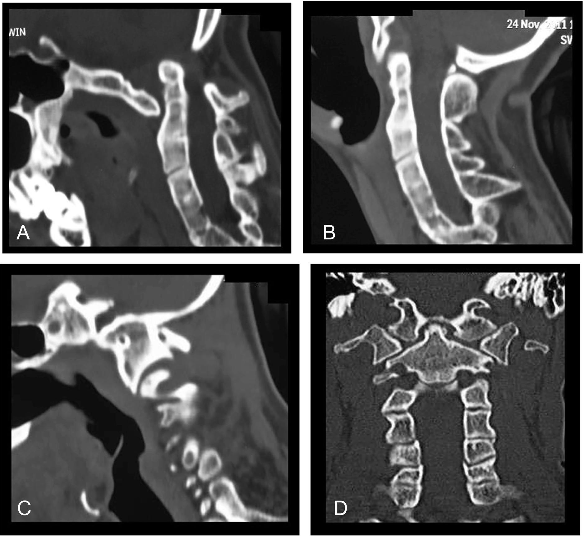 Fig. 7, (A) CT scan showing multiple segmental spinal fusions. In the neutral head position and when head is in extension position, there is no evidence of instability or basilar invagination. (B) CT scan with the head in flexed position showing basilar invagination in the form of vertical or superior migration of the odontoid. (C) CT scan cut through the facets showing no significant malalignment. (D) Coronal image showing a marked neck deformity.