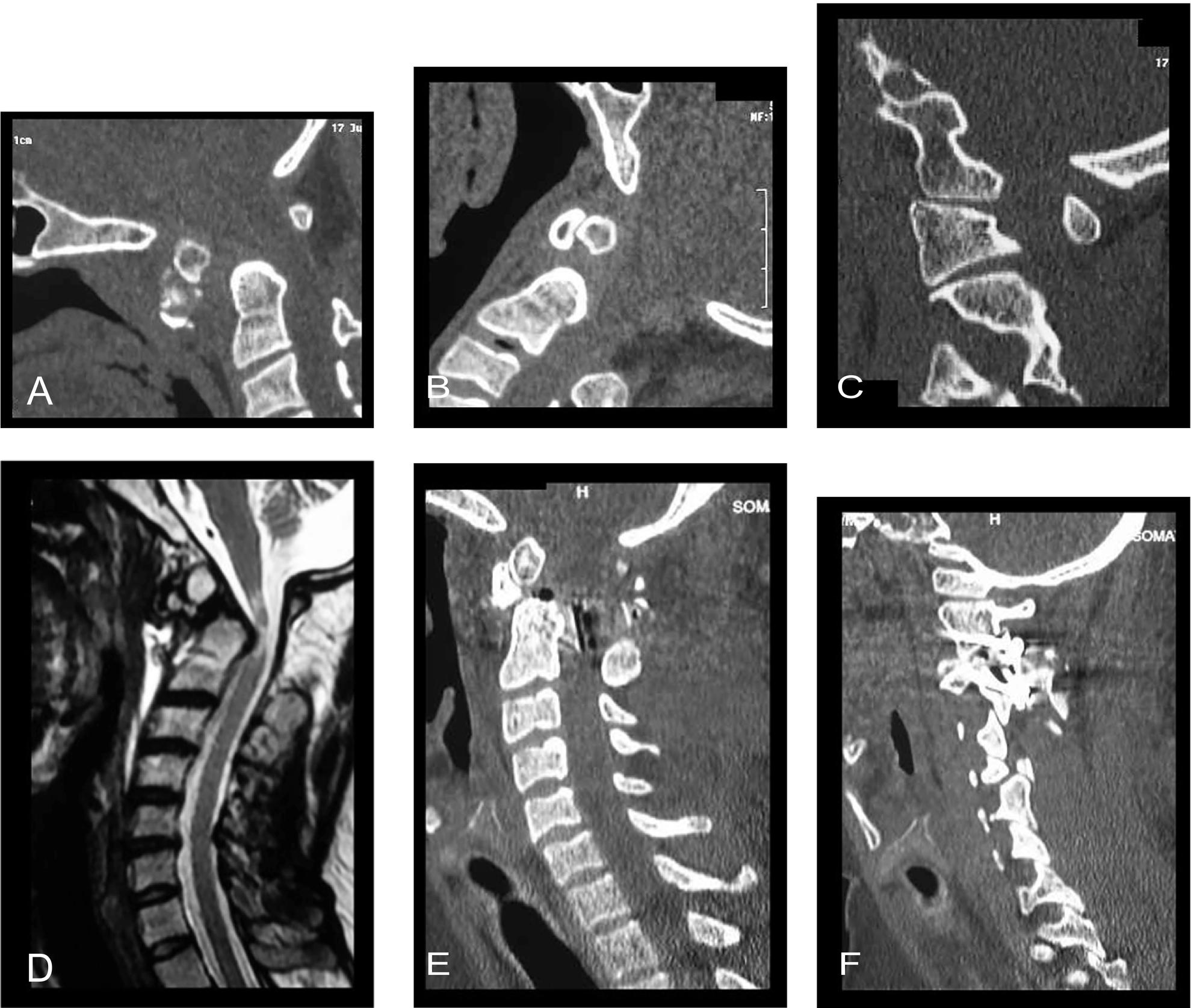 Fig. 8, (A) CT scan with the head in flexion shows atlantoaxial dislocation. Os-odontoideum can be seen. (B) CT scan with the head in extension position showing reduction of the dislocation. (C) Lateral cut of the CT scan passing through the facets. (D) T2-weighted magnetic resonance image showing cord compression. (E) Postoperative CT scan showing atlantoaxial fixation in reduced position. (F) Image showing the implants in the facets of atlas and axis.