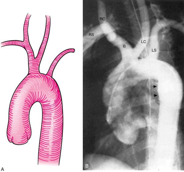 Fig. 40.3, Common origin of left common carotid and brachiocephalic arteries (i.e., bovine arch).