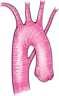 Fig. 40.5, Schematic drawing of the right aortic arch with aberrant left subclavian artery. (From Kadir S. Atlas of Normal and Variant Angiographic Anatomy . Philadelphia: WB Saunders; 1991.)