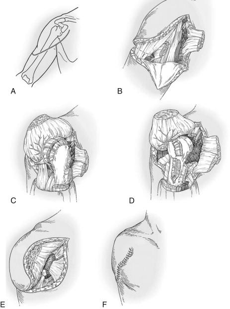 FIGURE 1, Shoulder disarticulation. A, Skin incision; B, Pectoralis major muscle detached, vessels ligated; C, Deltoid, Biceps and Coracobrachialis detached; D, Triceps and rotator cuff detached; E, Muscular closure (myodesis); F, Skin closure.