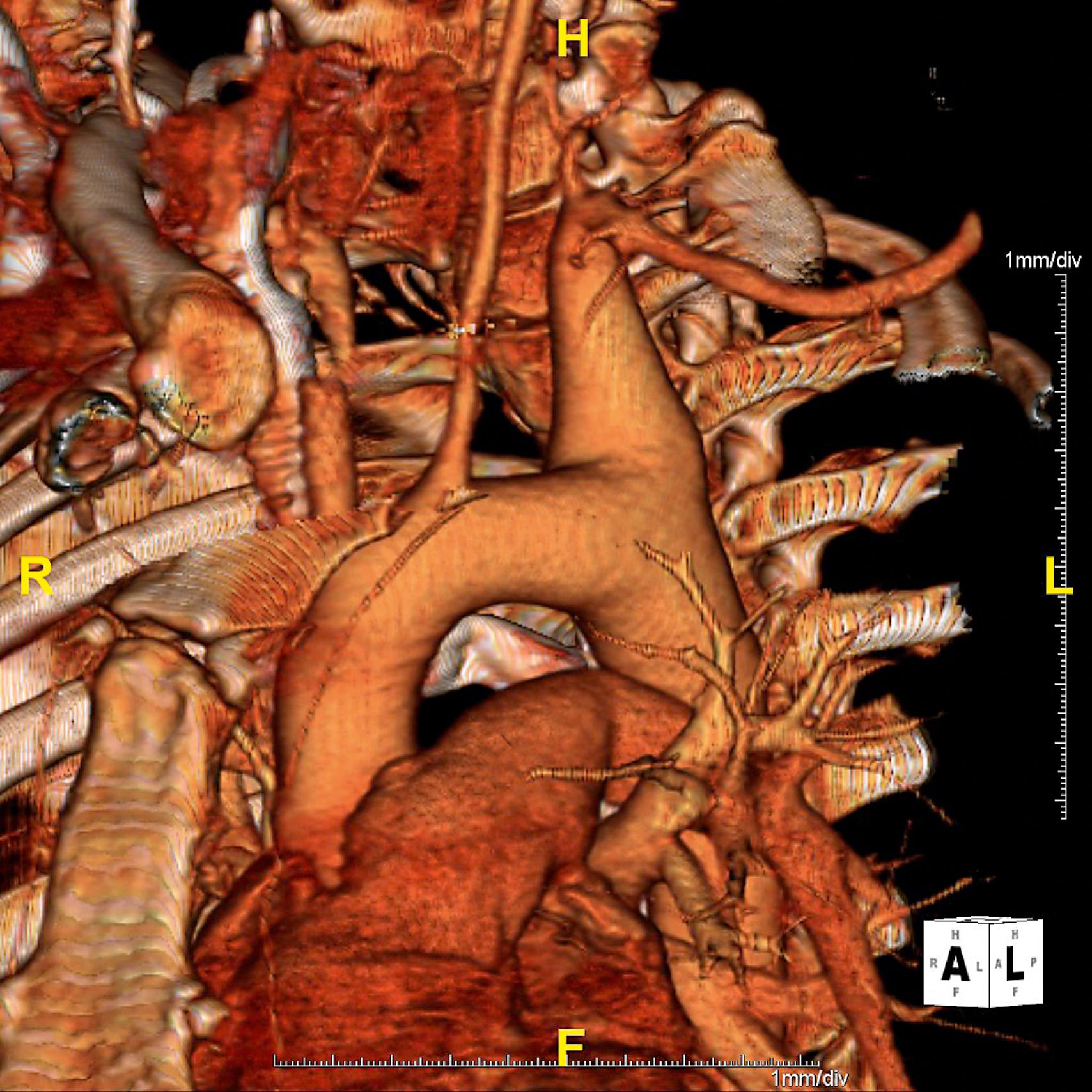 Figure 86.1, Three-dimensional computed tomography reconstruction of an aortic arch demonstrating an isolated aneurysm of the proximal left subclavian artery involving the aortic origin.