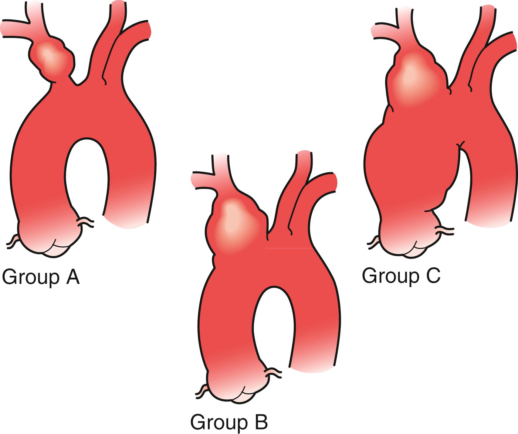 Figure 86.2, Classification of aneurysms of the innominate artery according to extent of involvement. Group A , no involvement of origin of the innominate artery. Group B , involvement of origin of the innominate artery but not of aorta. Group C , involvement of innominate artery and aorta.