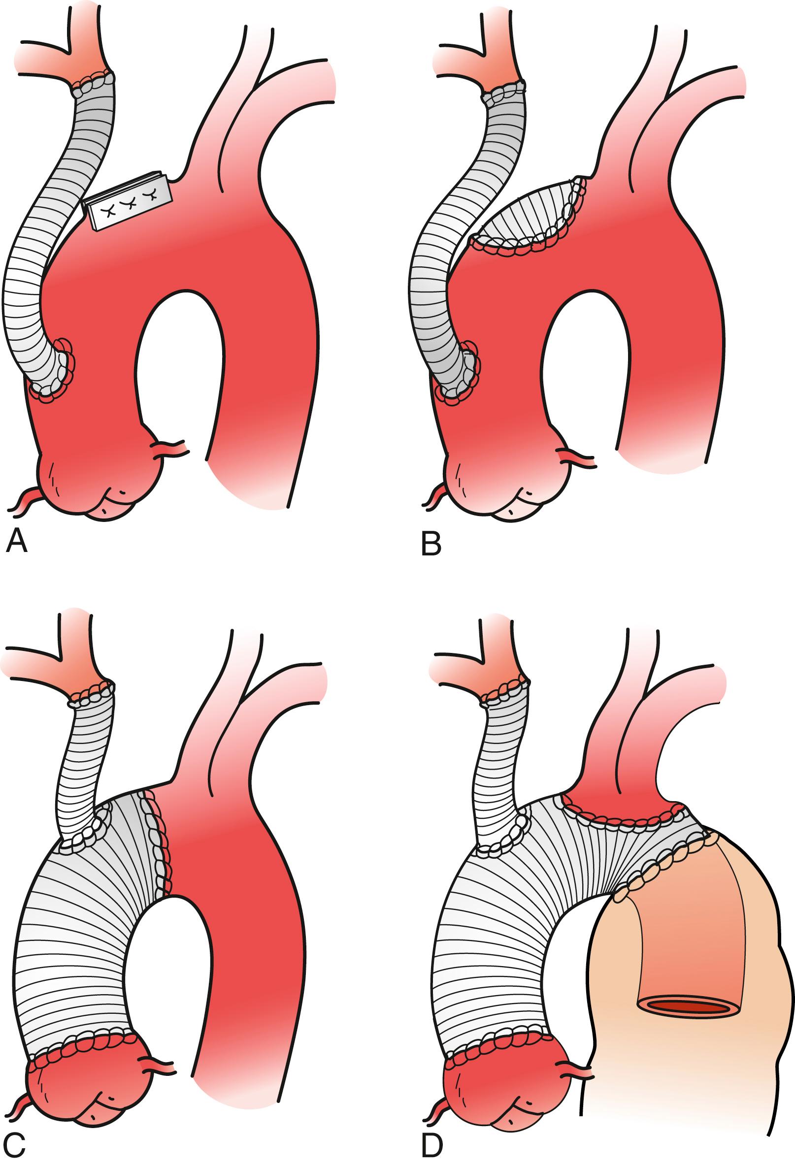 Figure 86.3, Techniques Used for Treatment of Aneurysms of the Innominate artery. ( A ) Lateral suture of aorta. ( B ) Patch angioplasty of aorta. ( C ) Replacement of ascending aorta. ( D ) Replacement of ascending aorta and transverse aortic arch in association with distal elephant trunk prosthesis.