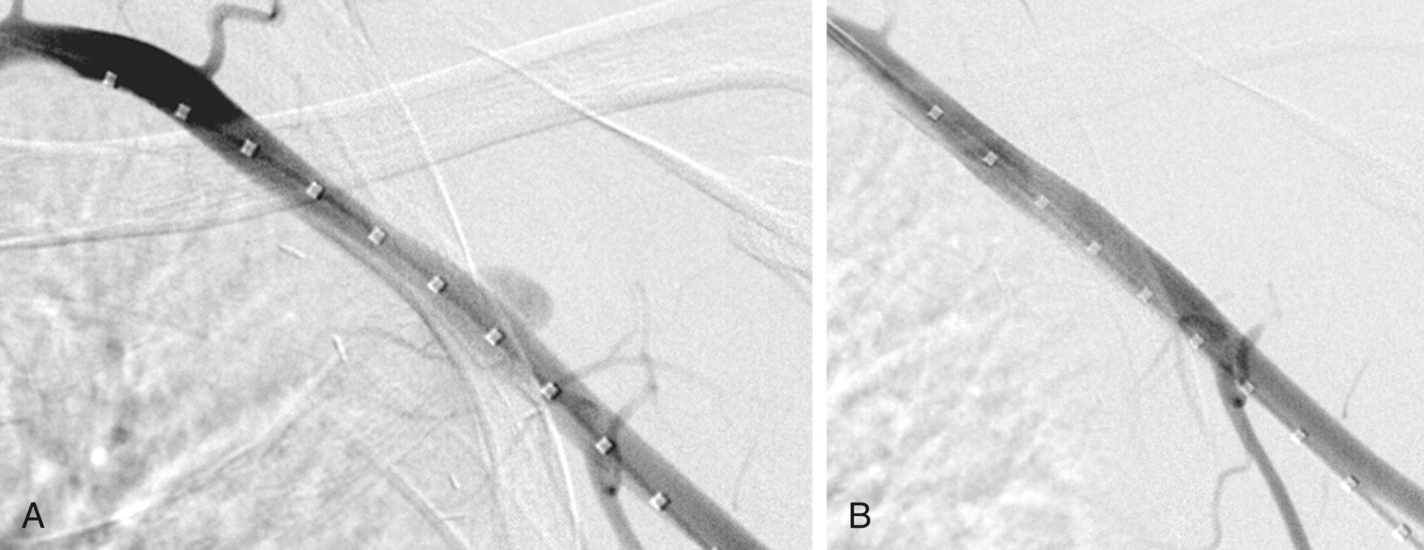 Figure 121.1, ( A ) Angiography of the left arm after penetrating trauma reveals a pseudo-aneurysm off the axillary artery. ( B ) After deployment of a covered stent graft in the axillary artery, no further extravasation is seen.