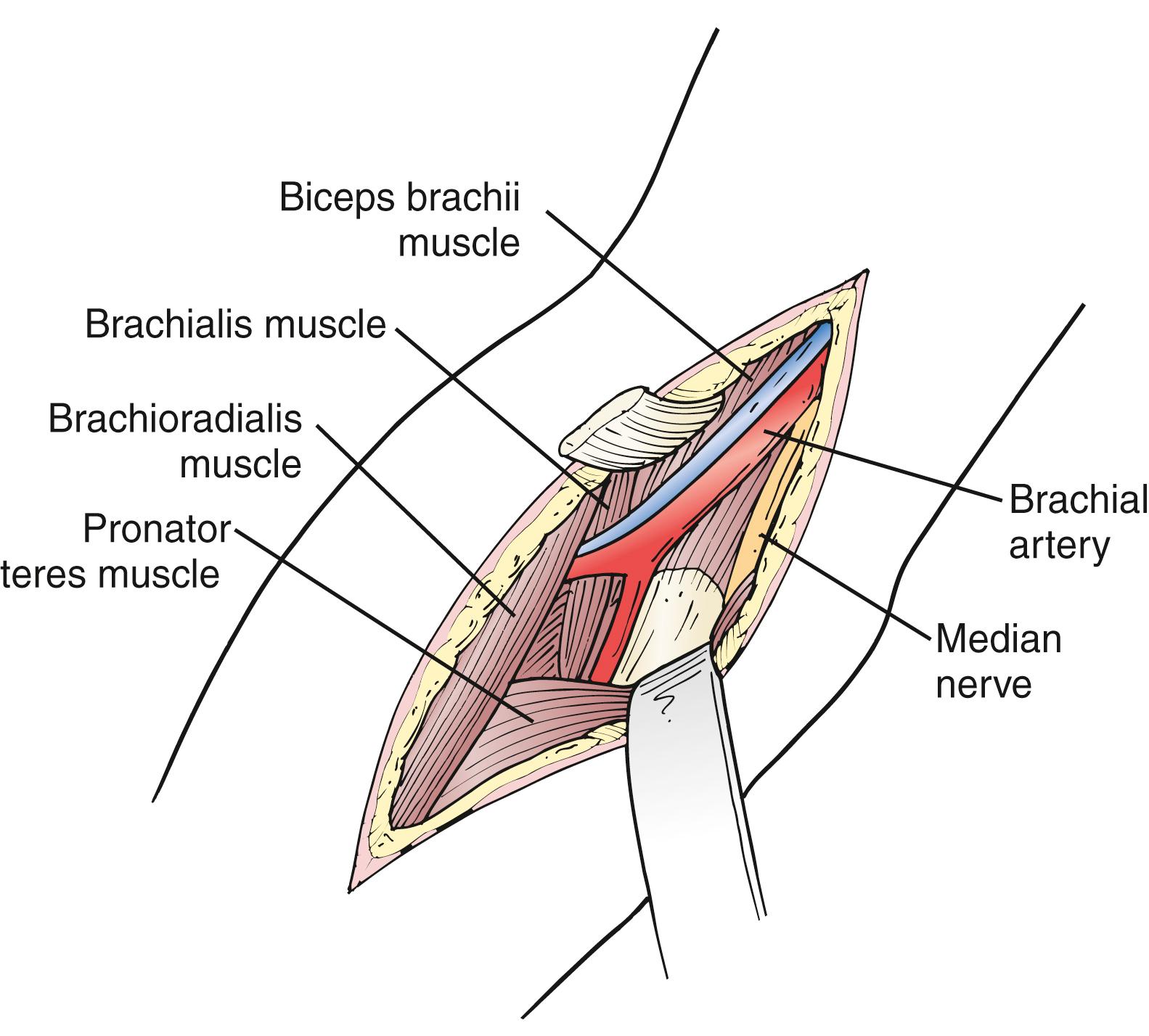 Figure 121.4, Exposure of the Brachial Artery at the Elbow.