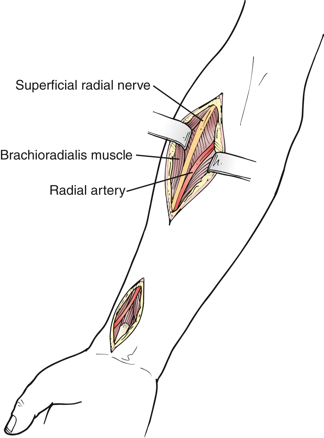 Figure 121.5, The radial artery in the midforearm can easily be exposed beneath the brachioradialis.