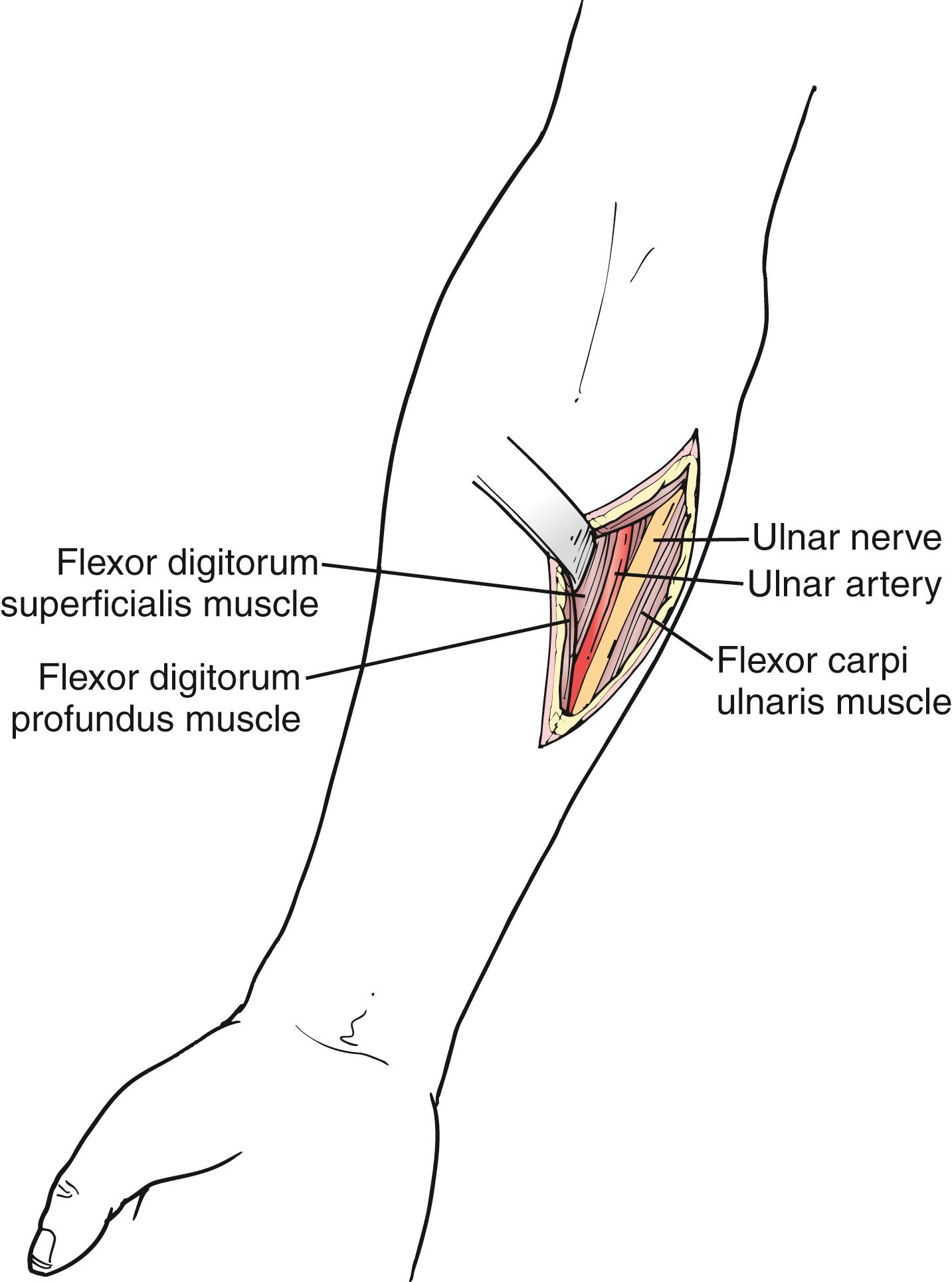 Figure 121.6, Exposure of the Forearm Ulnar Artery.