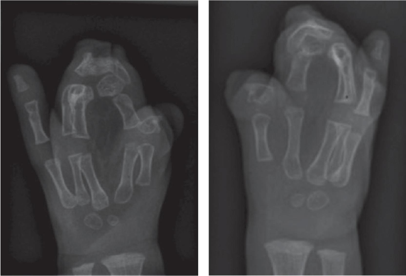 Fig. 71.1, A 2-Year-Old Male With Apert Syndrome and Complex Syndactyly Who Underwent Bilateral Staged Reconstruction During the Course of 2 Years .