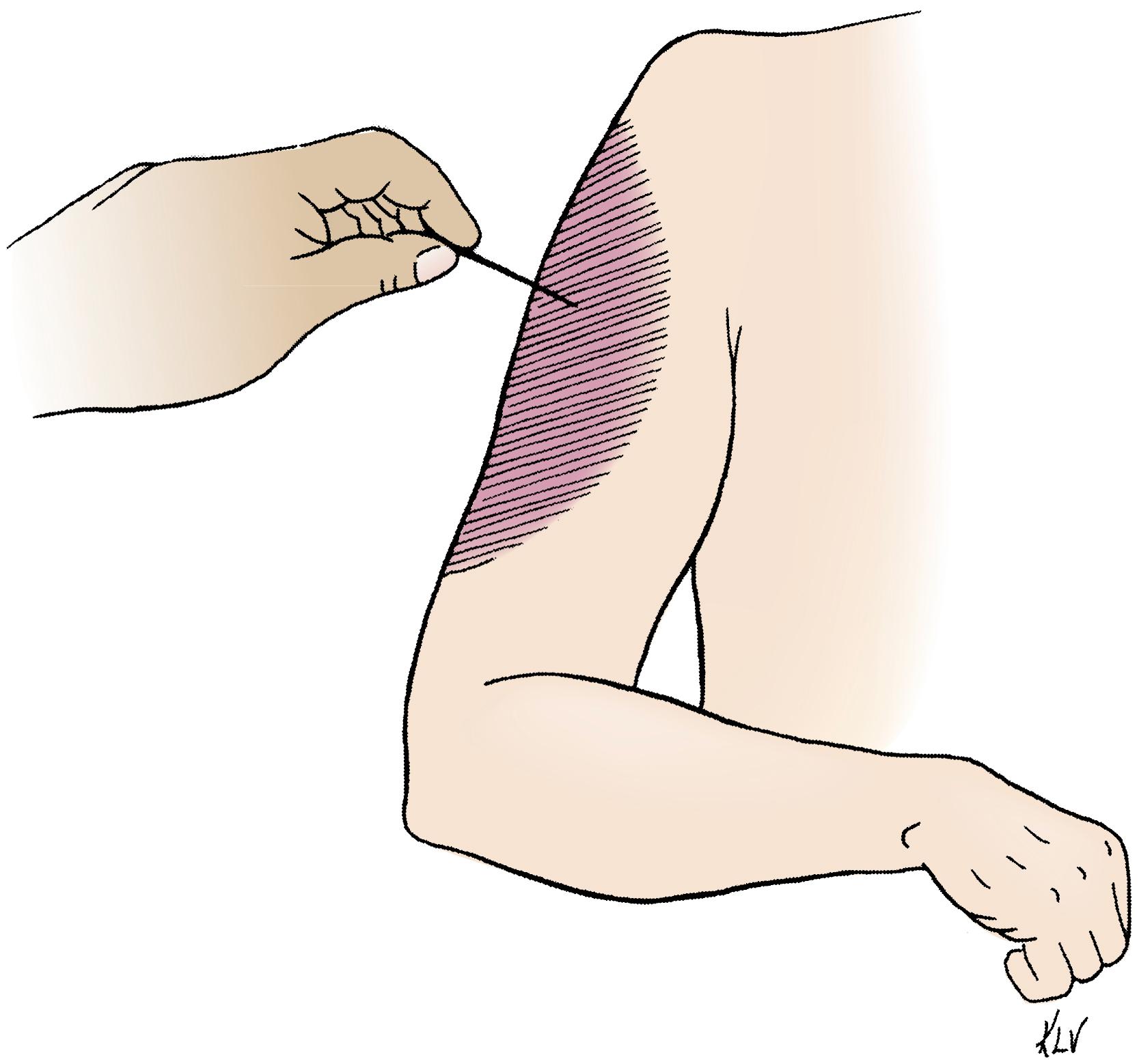 FIG. 29.16, Sensory distribution of the axillary nerve.