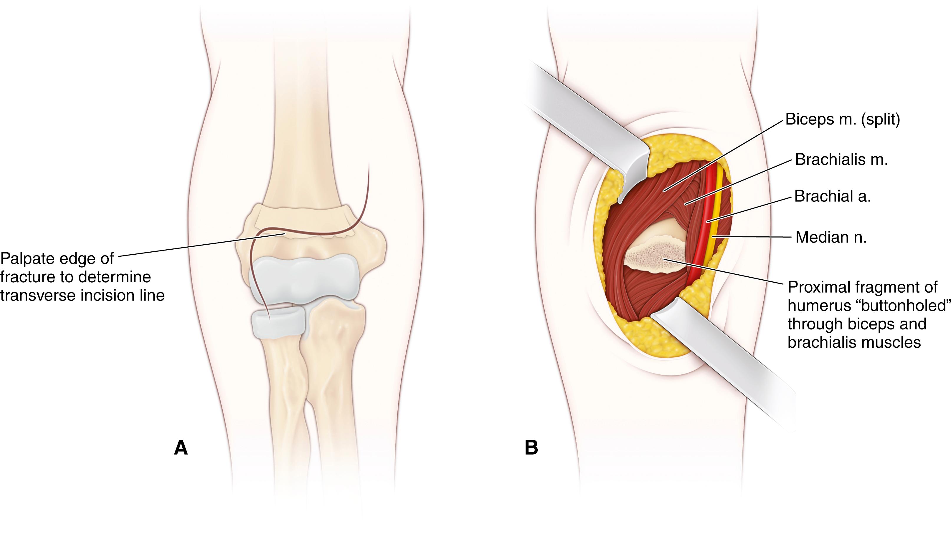 FIG. 29.45, Anterior approach to a supracondylar fracture. (A) The transverse skin extension at the antecubital fossa can be extended proximal-medially and distal-laterally. (B) Appearance after superficial layers is incised. The metaphyseal spike has lacerated the brachialis and biceps brachii muscle bellies and has performed the dissection.