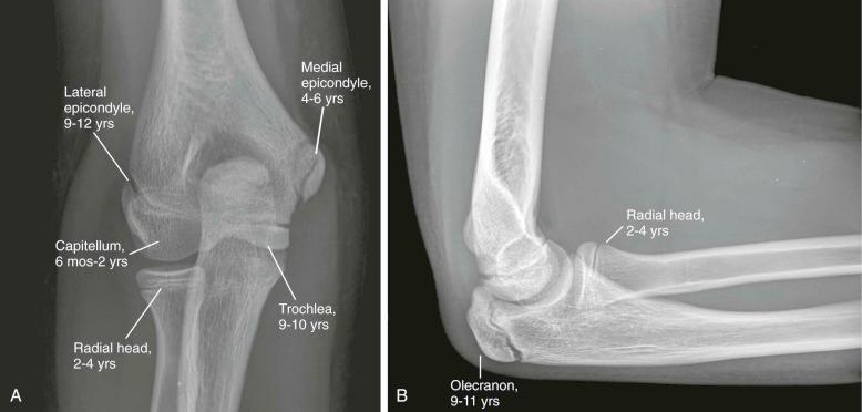 Upper Extremity Injuries in Children - Clinical Tree