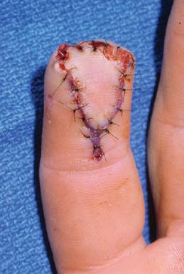 Figure 20.2, The defect in the fingertip is seen following reconstruction with a volar V-Y flap. The donor site is closed primarily.