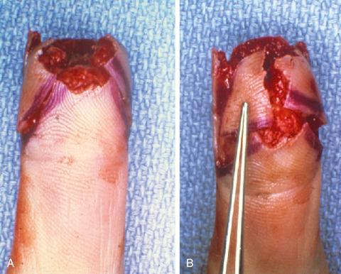 Figure 20.3, (A,B) Fingertip defect reconstructed with bilateral lateral V-Y flaps raised in a similar fashion to the volar V-Y flap but because of fibrous septae, limited advancement is achieved.