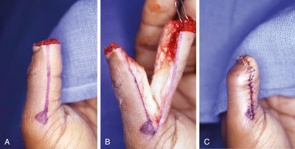 Figure 20.4, (A–C) Tip of thumb defect reconstructed with a Moberg V-Y flap. The flap is elevated at the skeletal plane just above the flexor pollicis longus tendon and sheath. The distal phalanx is flexed to accommodate greater advancement.