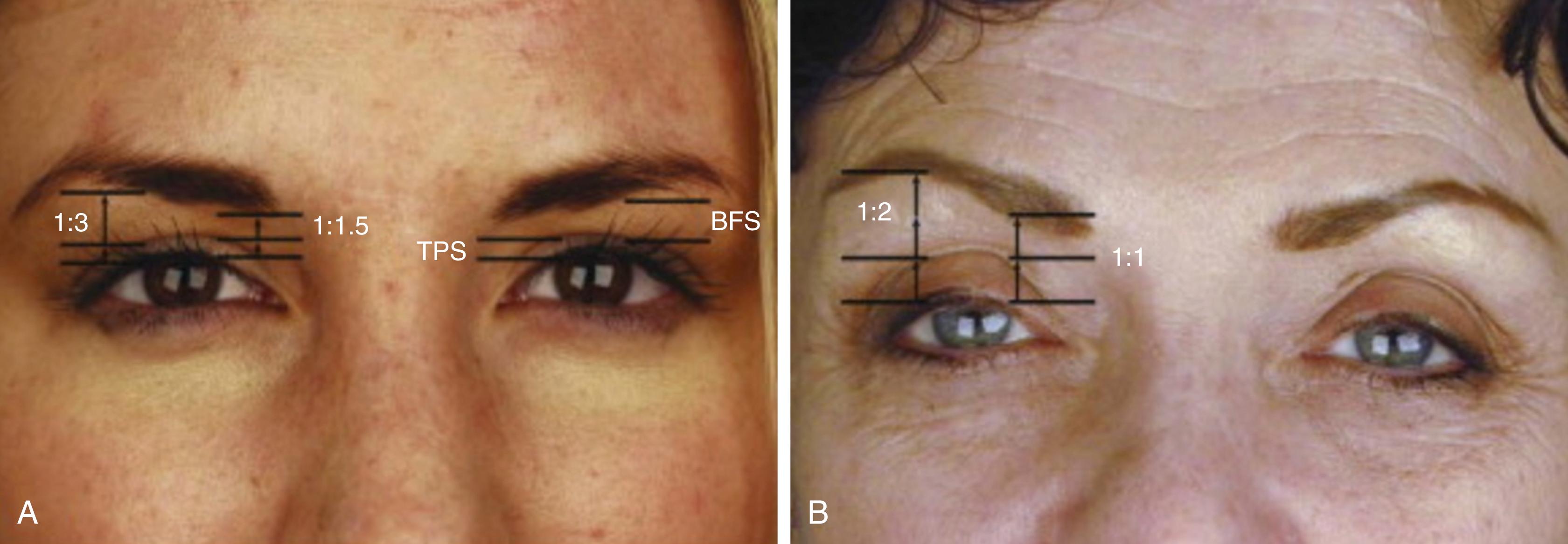 Fig. 64.1, (A) The tarsal platform show (TPS) is the distance from the lash line to the upper lid crease. The brow–fat span (BFS) is the distance between the lid crease and inferior edge of the brow. The youthful TPS to BFS ratio is 1:1.5 medially and 1:3 laterally. (B) With age, bone, and soft tissue loss around the eye increases the amount of TPS and decreases the BFS. In some patients, this can give the illusion of brow ptosis, when in fact the actual distance of the brow from the lash line is the same or even increased.