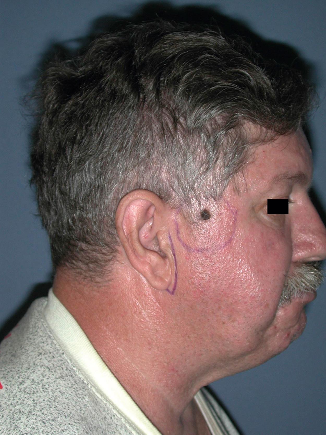 Fig. 2.1, A preoperative view showing a melanoma in the temporal and upper facial regions and an outline of potential margin for the wide local excision.