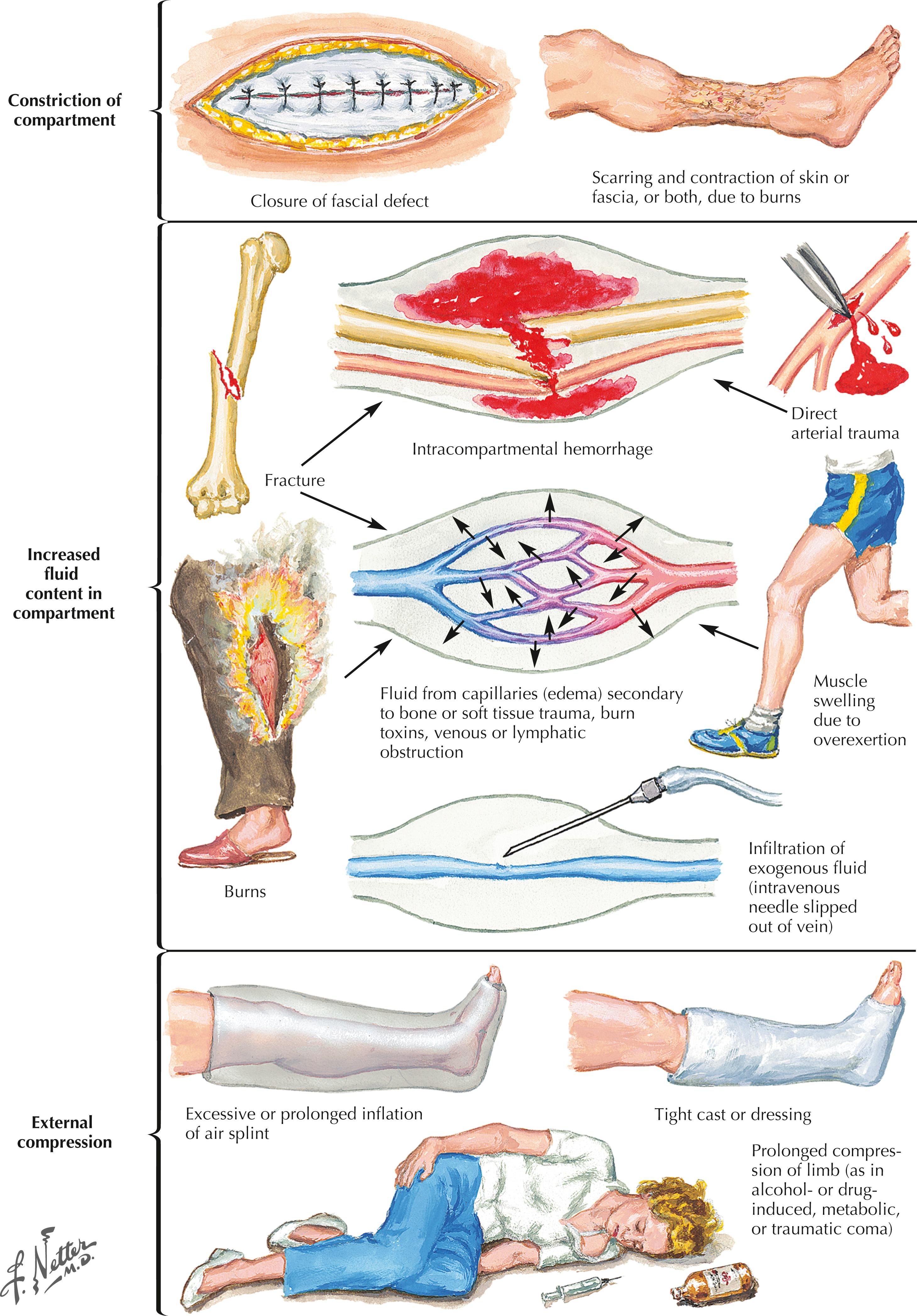 FIGURE 54.1, Etiology of compartment syndrome.