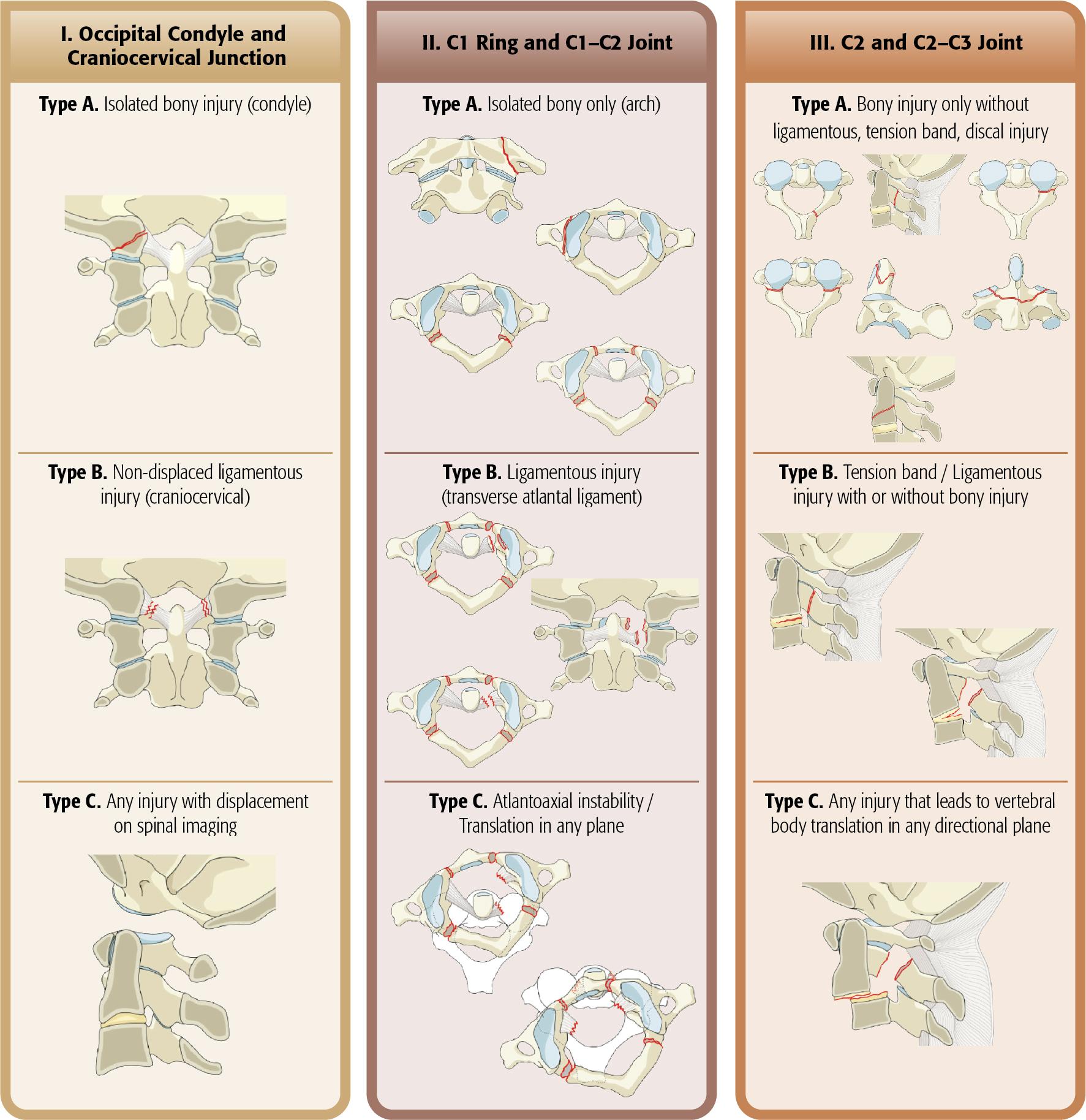 Fig. 56.1, AOSpine upper cervical classification system. (AOSpine International, Switzerland. AOSpine is a clinical division of the AO Foundation—an independent medically guided nonprofit organization.)