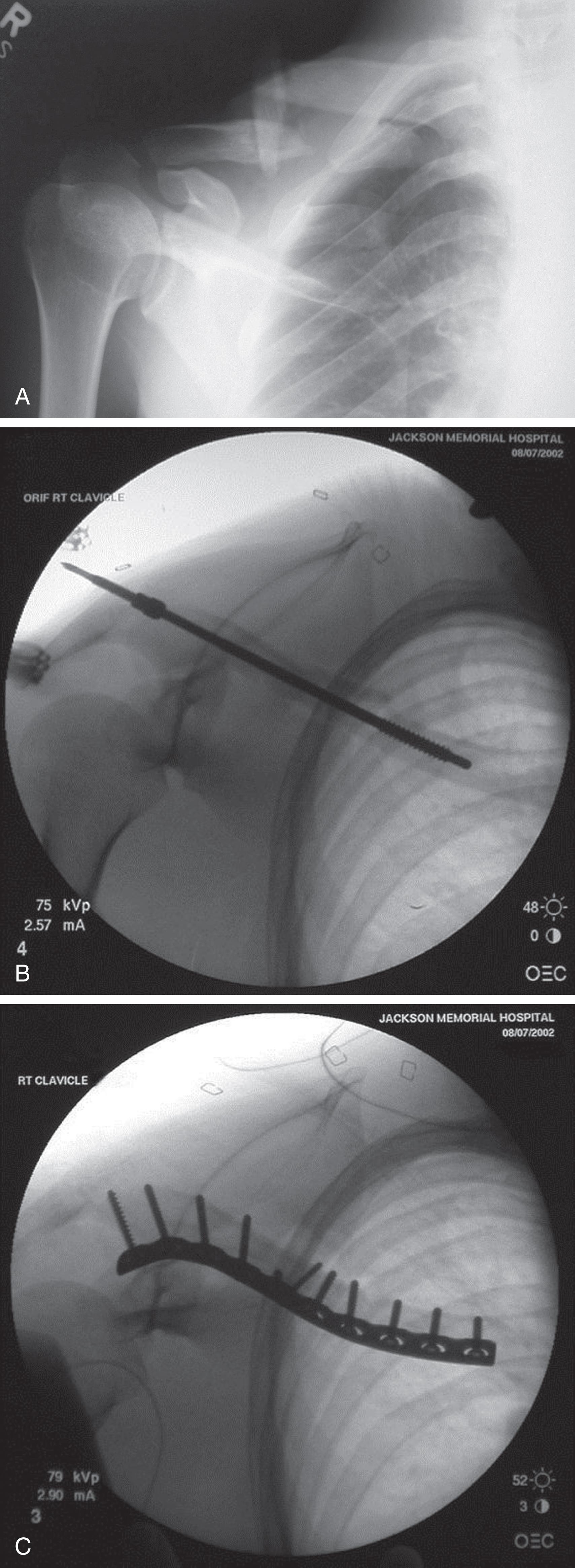 FIGURE 3, A comminuted displaced midshaft clavicle fracture (A) may be fixed with either an intramedullary device (B) or with a plate and screws (C).