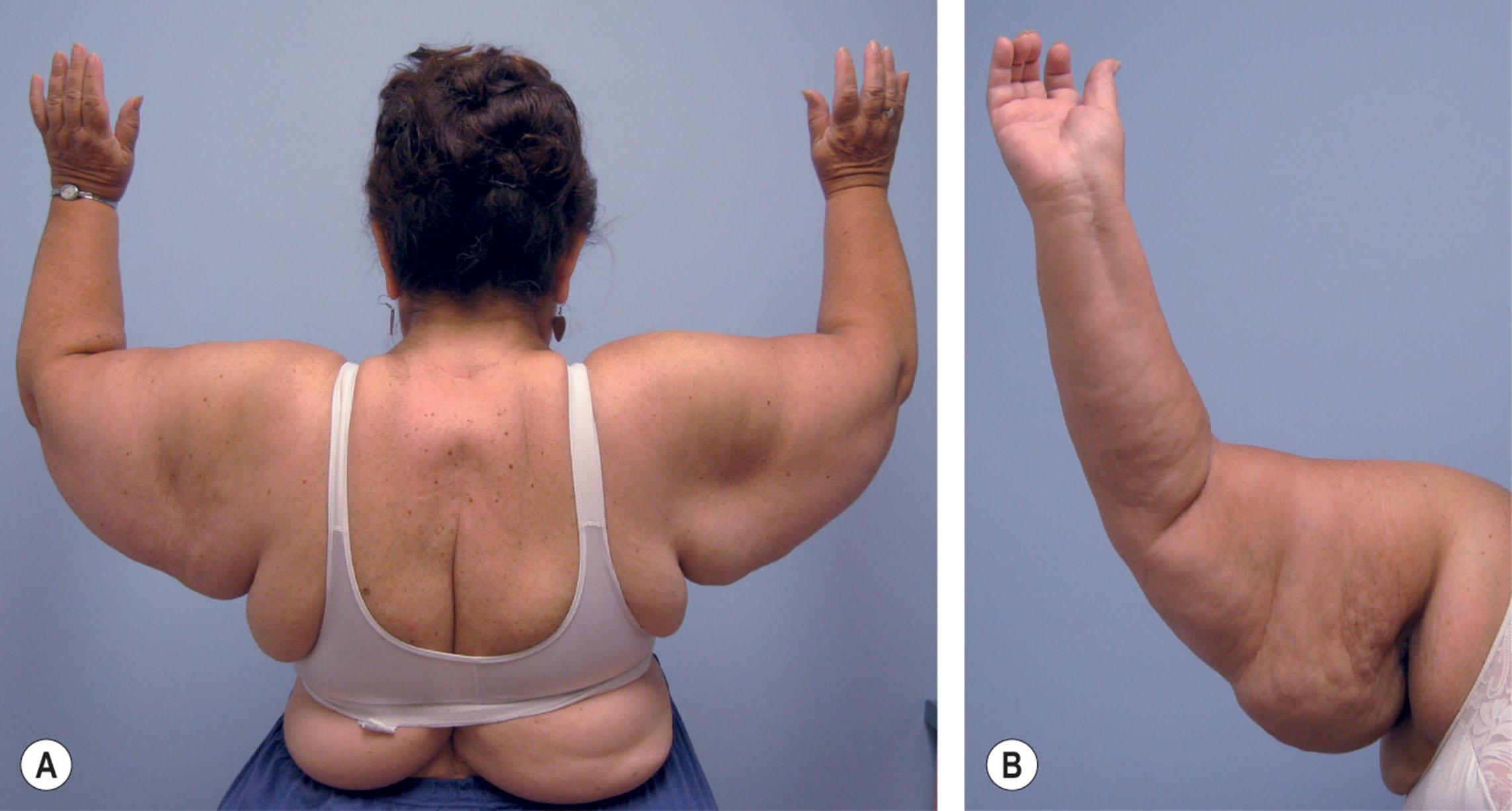 Figure 36.1, (A,B) Morbidly obese 69-year-old woman. Fat deposits are most prominent along axilla and posterior arm and, to a lesser degree, anterior arm.