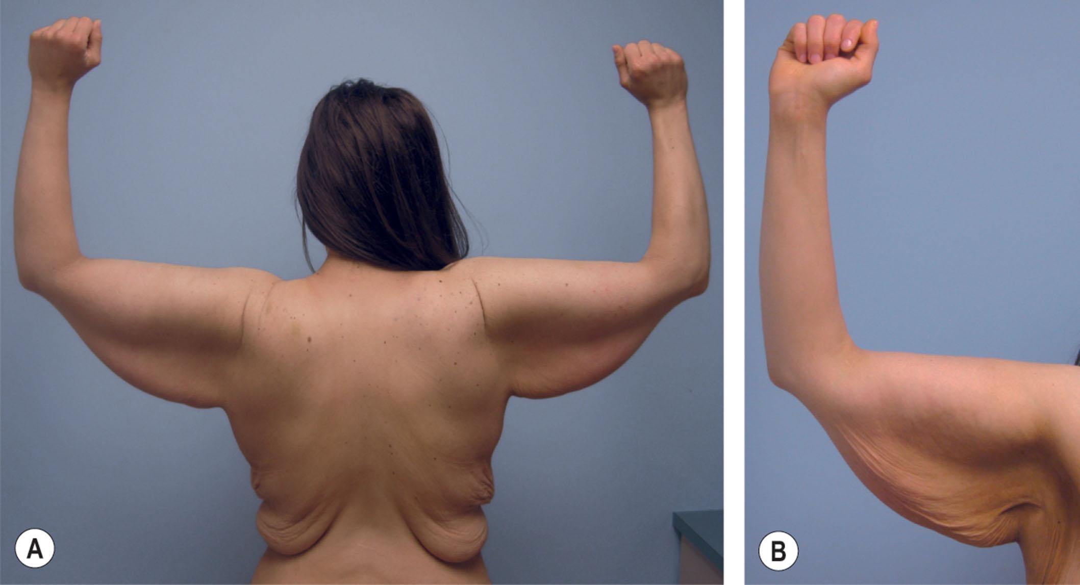 Figure 36.2, (A,B) A 28-year-old woman, 6 years following 185 lb (84 kg) weight loss. Her current weight and body mass index are 188 lb (85 kg) and 27, respectively. Note extreme degree of soft-tissue excess.