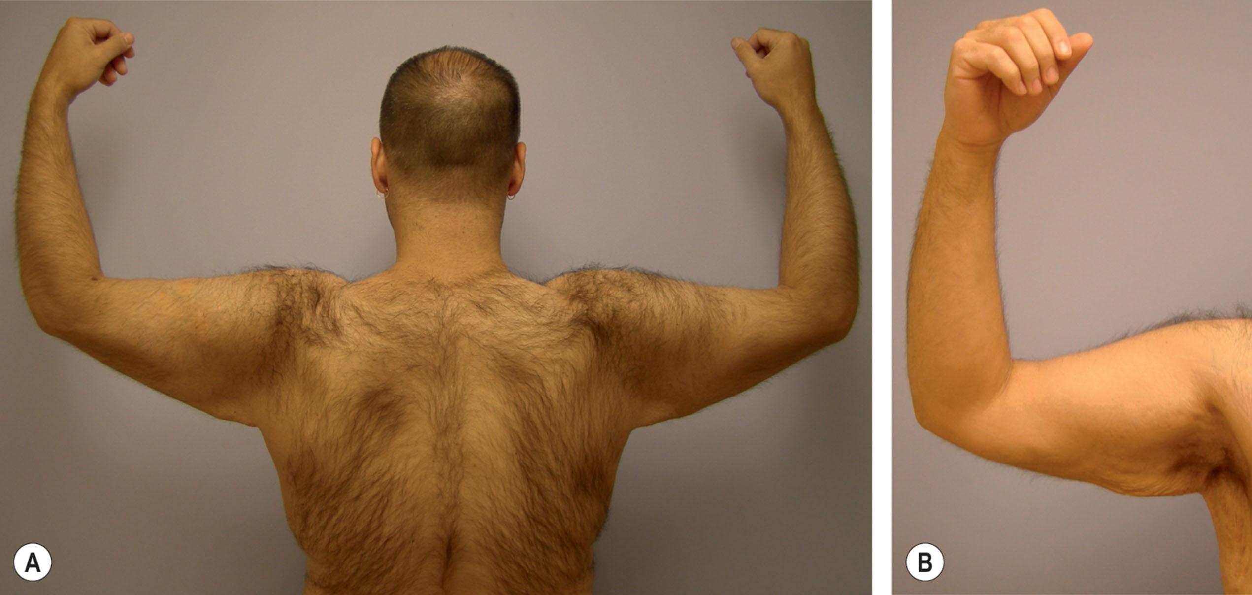 Figure 36.5, (A,B) A 35-year-old man following weight loss of 128 lb (58 kg). Note that the contour deformity is primarily limited to the axilla and proximal half of the arm.