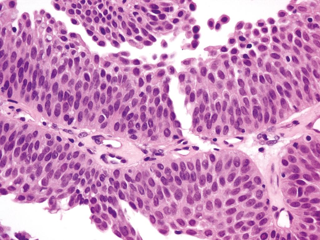 Figure 10.11, Papillary urothelial neoplasm of low malignant potential.