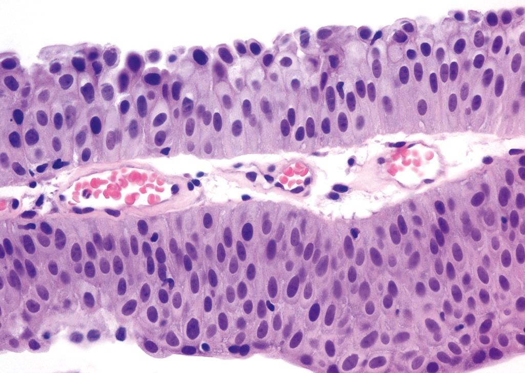 Figure 10.12, Noninvasive low-grade papillary urothelial carcinoma.