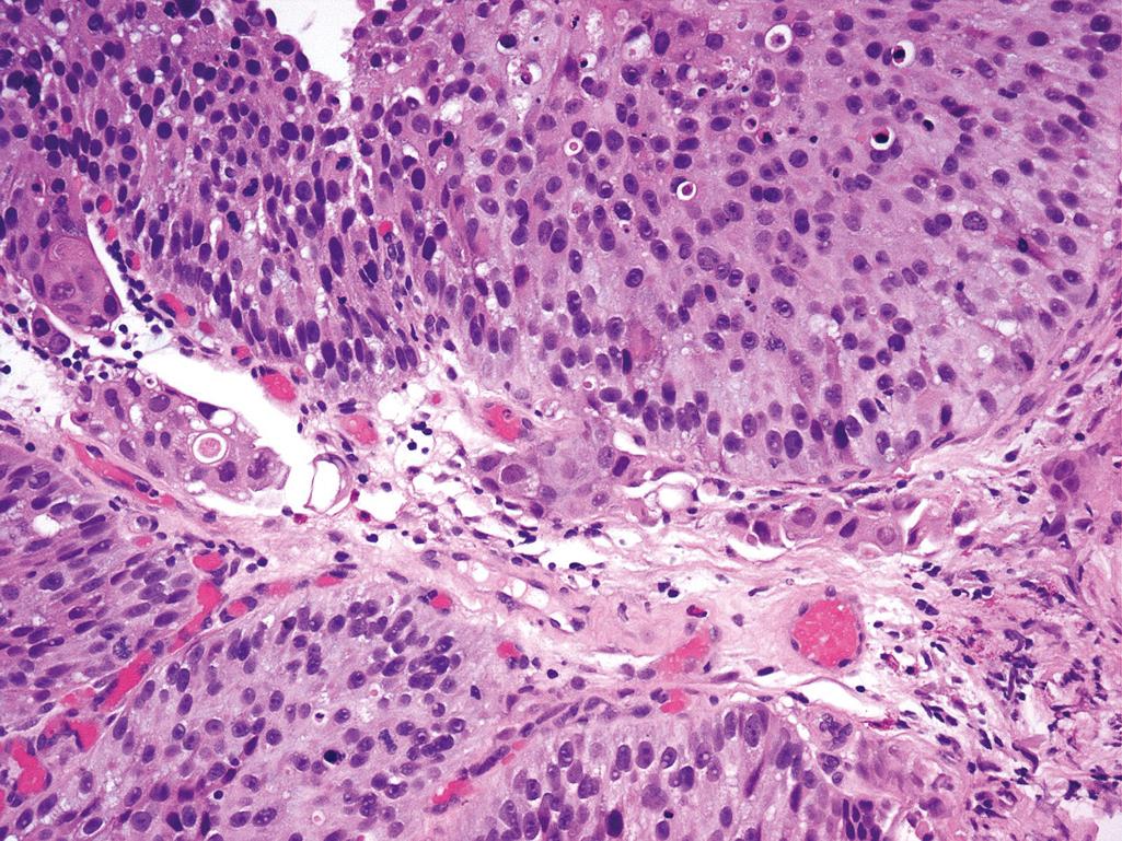 Figure 10.14, High-grade urothelial carcinoma invading lamina propria.